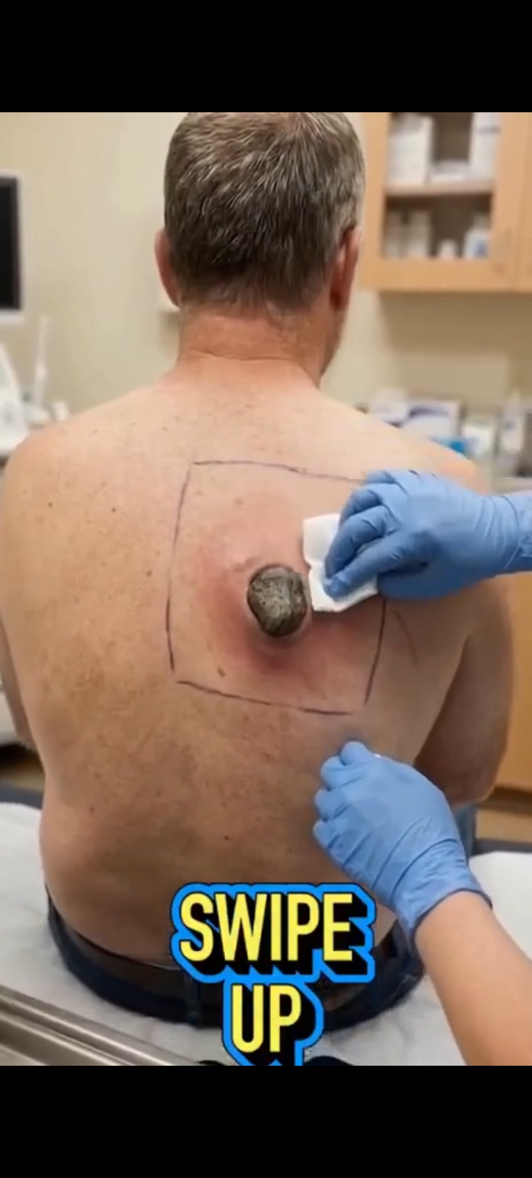 The Large Back Lump That Needed Medical Attention: Understanding Inflamed Skin Cysts